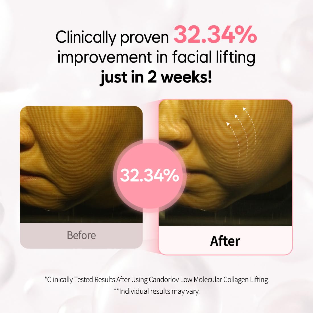 CANDORLOV Overnight Collagen Lifting Gel Mask 5 pcs, Korean Face Lifting Deep Hydrogel Mask for Glass Skin, Anti-Aging with PDRN (Salmon DNA), Hyaluronic Acid for Elasticity, Firmness