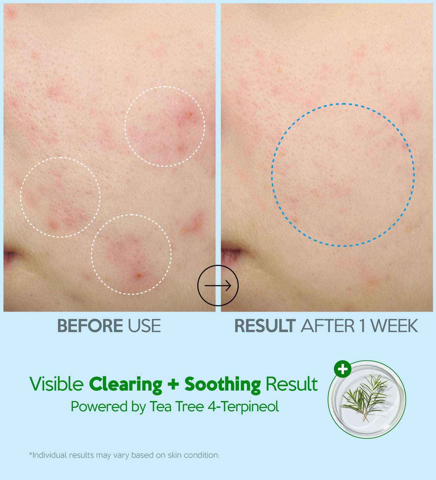 Troubless Hydro Soothing Moisture Cream - Deep Hydration & Skin Barrier Cream for Face w/ 10,000 ppm Panthenol & Tea Tree 4-Terpineol - Soothing & Non-Greasy Face Moisturizer (2.36 fl oz)