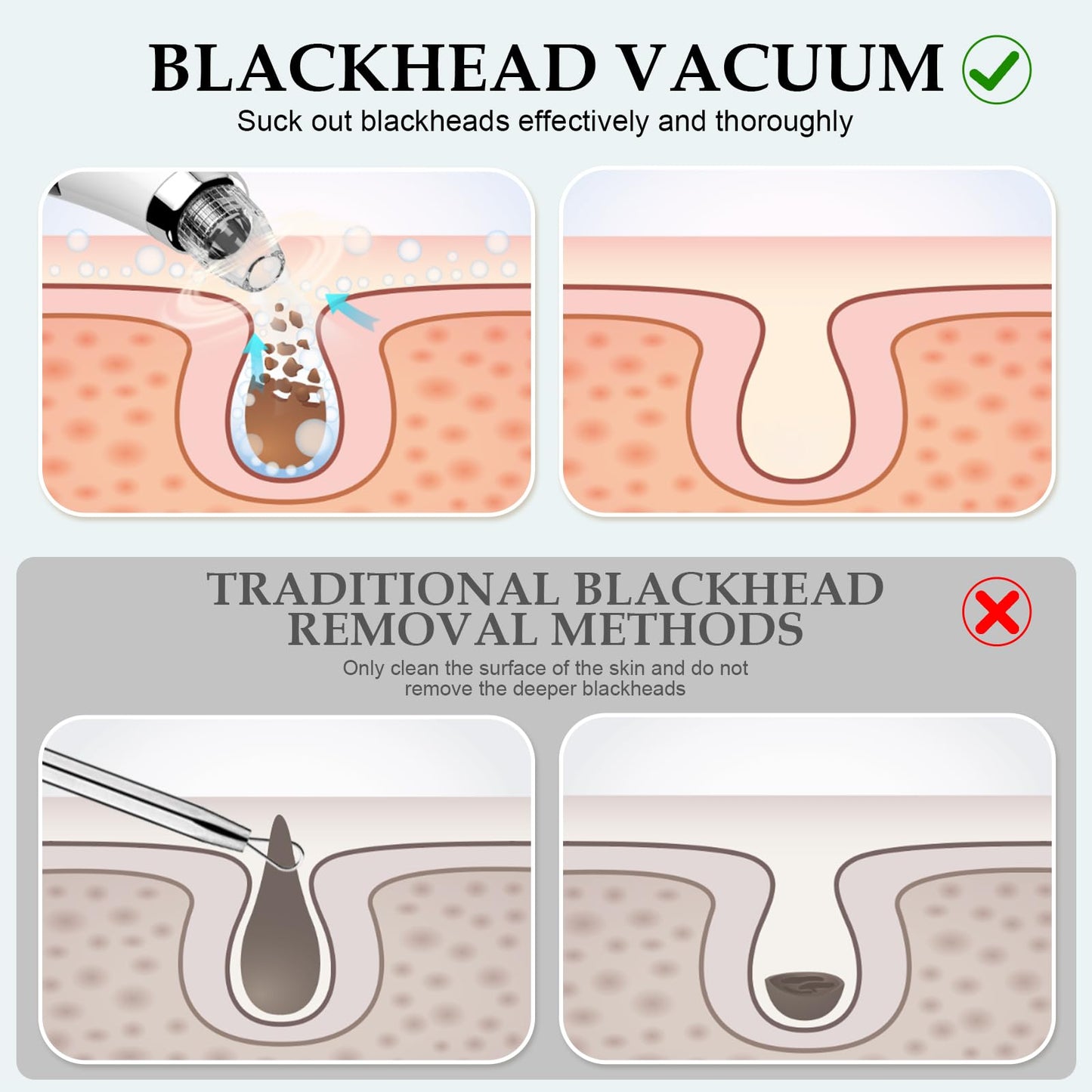 Blackhead Vacuum Removers - Pore Vacuum for Face with 5 Attachments & 3 Suction Levels - USB Rechargeable Blackhead Remover Tools for Women and Men (White)