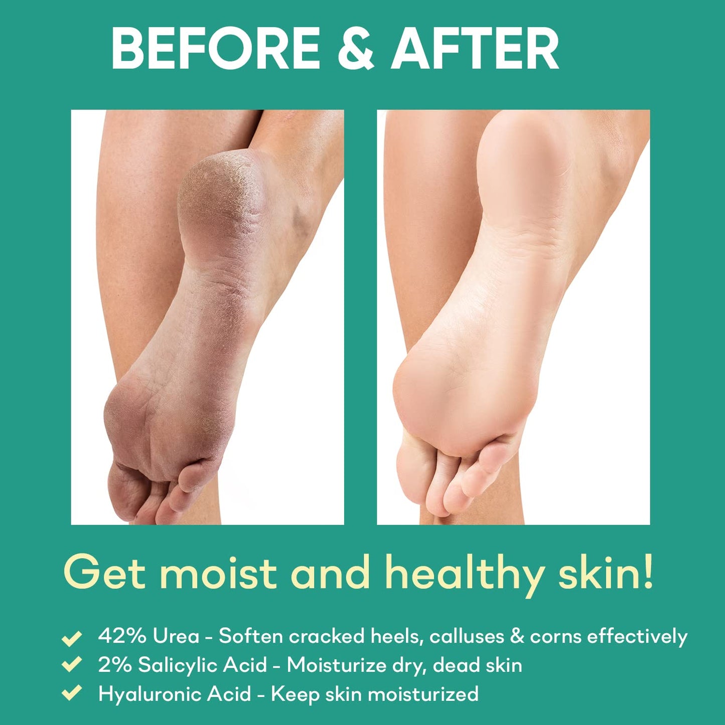 Ellocy 42% Urea Gel Max Plus Salicylic & Hyaluronic Acid - cracked heel repair callus remover gel for Elbows, Feet, and Hands, and cracked heel, calloused feet remover gel 4oz