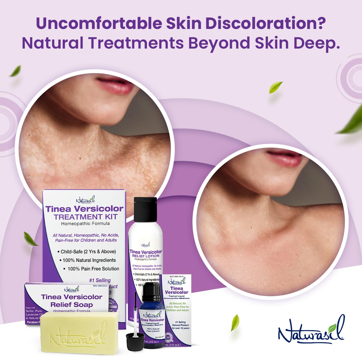 Naturasil Tinea Versicolor Treatment Max-Strength 10x Soap | Antifungal Micronized Sulfur | Stops Tinea, Pityriasis, Candida, Ringworm Jock Itch & Irritation | Fast Acting Adult & Kid Safe | 4 oz Bar