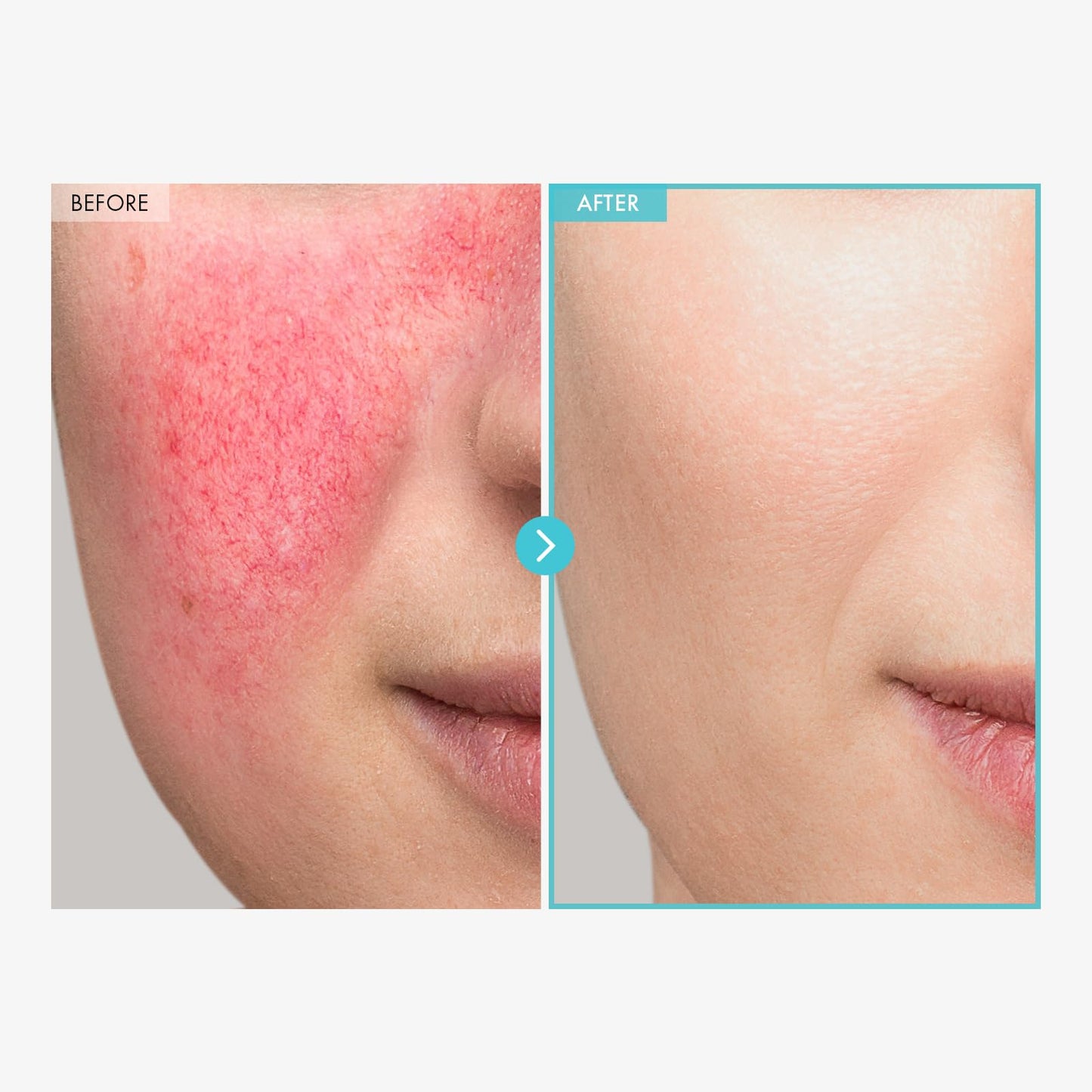 TOSOWOONG SOS Repair CICA Clinic Zinc Cream, 100,000ppm Zinc Oxide, Heal, Soothe Acne, Redness, Rosacea Treatment, Skin Barrier Repair, Moisture, Non-Comedogenic, Korean Skincare, 50g, 1.76 oz.