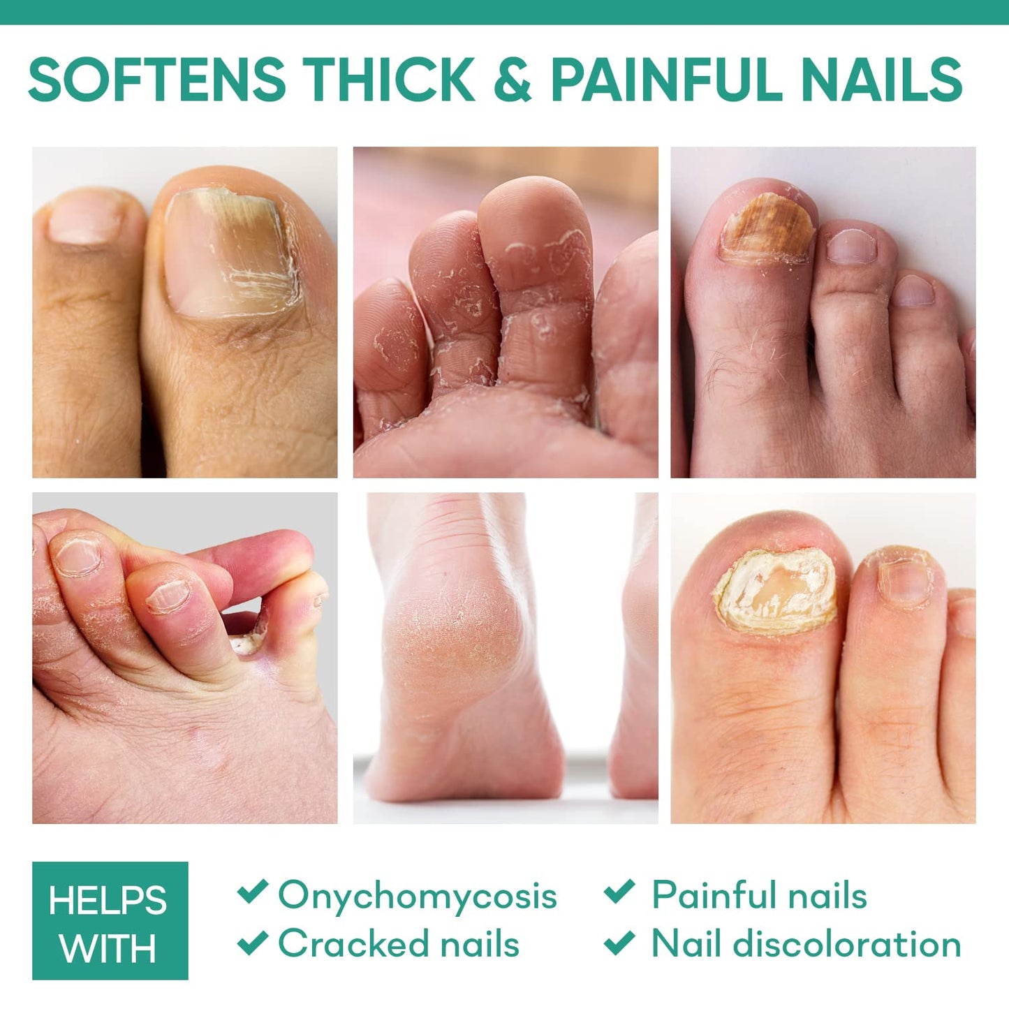 Ellocy 42% Urea Gel Max Plus Salicylic & Hyaluronic Acid - cracked heel repair callus remover gel for Elbows, Feet, and Hands, and cracked heel, calloused feet remover gel 4oz