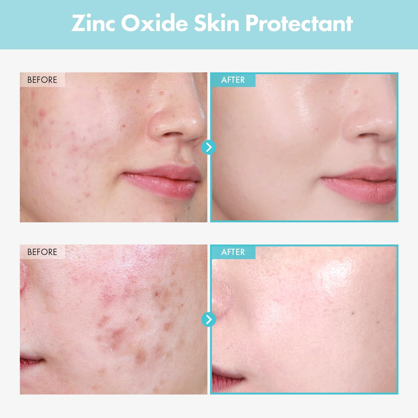 TOSOWOONG SOS Repair CICA Clinic Zinc Cream, 100,000ppm Zinc Oxide, Heal, Soothe Acne, Redness, Rosacea Treatment, Skin Barrier Repair, Moisture, Non-Comedogenic, Korean Skincare, 50g, 1.76 oz.