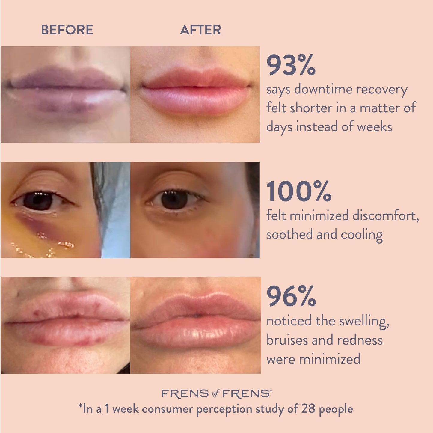 Frens of Frens Aesthetic Aftercare | TAKE After CARE Arnica & Bromelain Gel for Bruising, Swelling after Fillers, Cosmetic Injections | Cooling Depuff Serum Face Roller | 100% Vegan (60ml)