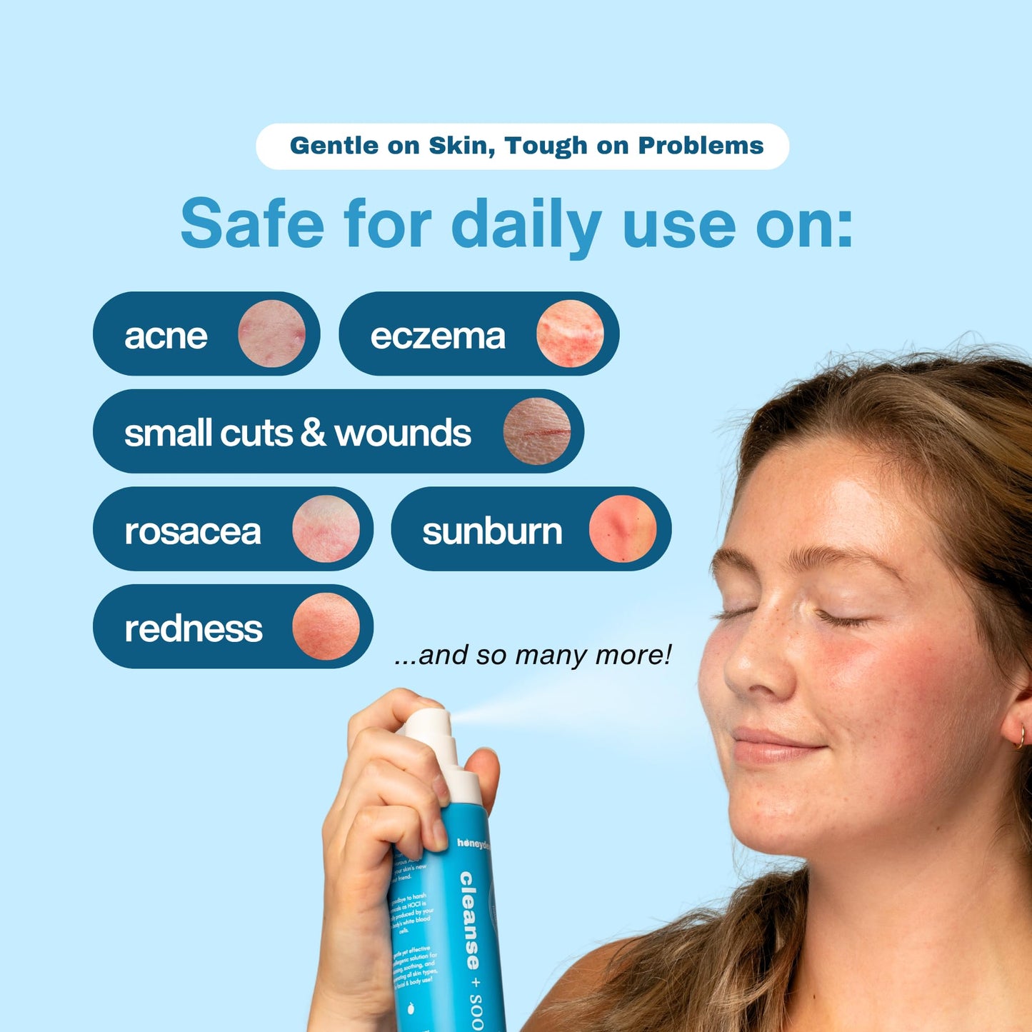 Honeydew Labs Hypochlorous Acid Spray – HOCl Face & Skin Mist for Acne, Eczema & Irritation – Multi-Purpose Skin Repair – Eyelid Cleanser, Post-Workout, Post-Procedure, Scalp, Sensitive Skin TSA 2 oz