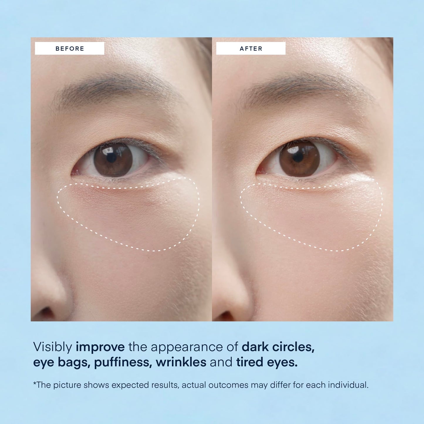 TEREZ & HONOR Under Eye Patches for Dark Circles - 60 Korean Hydrogel Masks for Puffiness, Bags with Caffeine, Hyaluronic Acid, Niacinamide - Undereye Brightening, Hydrating, Anti-Wrinkle & Cooling