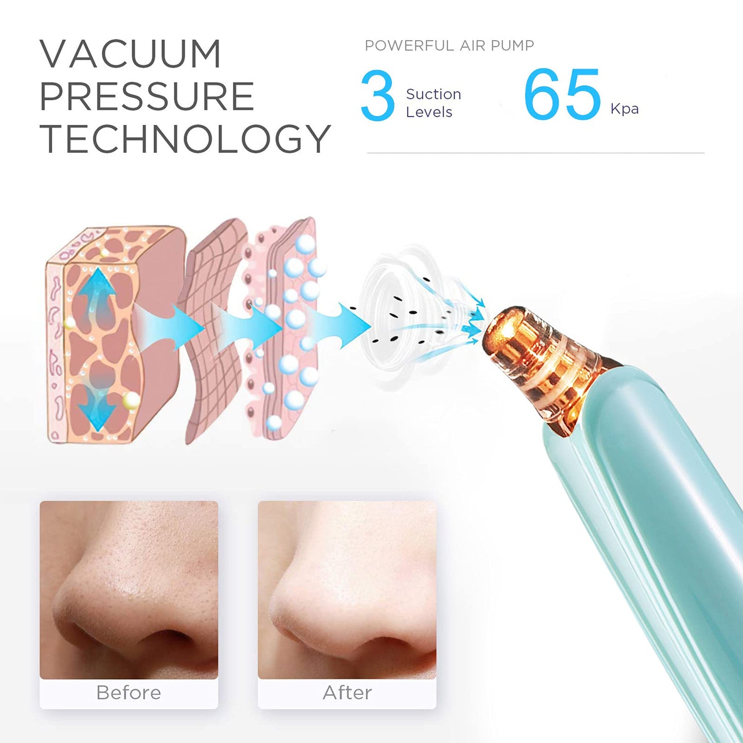 Blackhead Remover Pore Vacuum Cleaner - Upgraded Facial Pore Cleaner - Electric USB Pore Vacuum with 5 Probes - Upgraded Blackhead Suction Tool - Blackhead Remover Kit