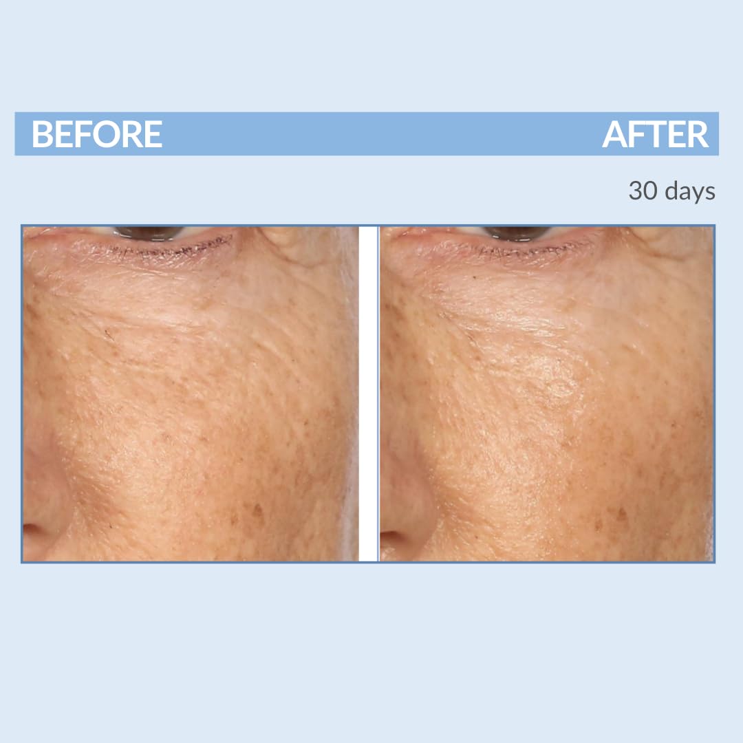 Retinol Fine Lines and Wrinkles Skin Care Set - A Force XR Serum and A Cream XR Moisture Cream for Face - Anti-Aging - Minimize Post Acne Marks - Resurface and Hydrate - Serious Skincare