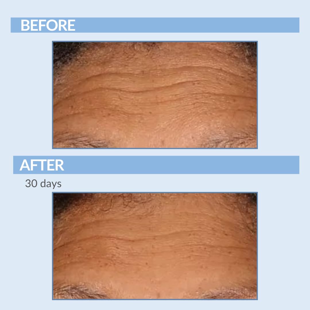 Retinol Fine Lines and Wrinkles Skin Care Set - A Force XR Serum and A Cream XR Moisture Cream for Face - Anti-Aging - Minimize Post Acne Marks - Resurface and Hydrate - Serious Skincare