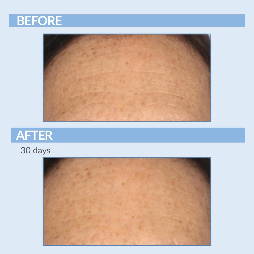 Retinol Fine Lines and Wrinkles Skin Care Set - A Force XR Serum and A Cream XR Moisture Cream for Face - Anti-Aging - Minimize Post Acne Marks - Resurface and Hydrate - Serious Skincare