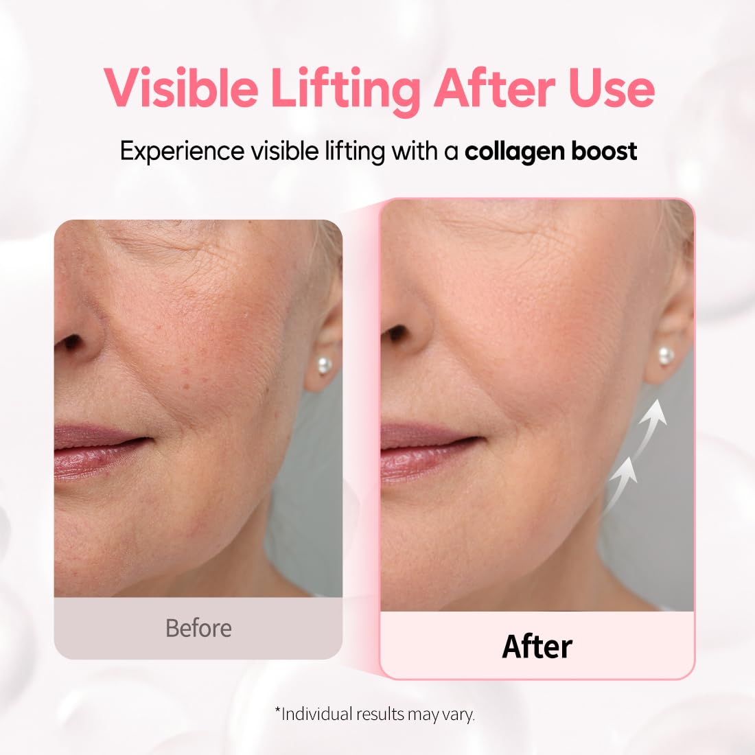 CANDORLOV Overnight Collagen Lifting Gel Mask 5 pcs, Korean Face Lifting Deep Hydrogel Mask for Glass Skin, Anti-Aging with PDRN (Salmon DNA), Hyaluronic Acid for Elasticity, Firmness