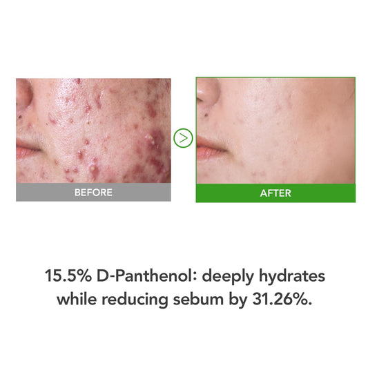 KIOSKIN 31% Reduction in Sebum & 15.5% High-Dose D-Panthenol – Calms Redness, Repairs Skin Barrier & Locks in Hydration – With Heartleaf Extract & Hyaluronic Acid – Korean Skincare Top Barrier Cream