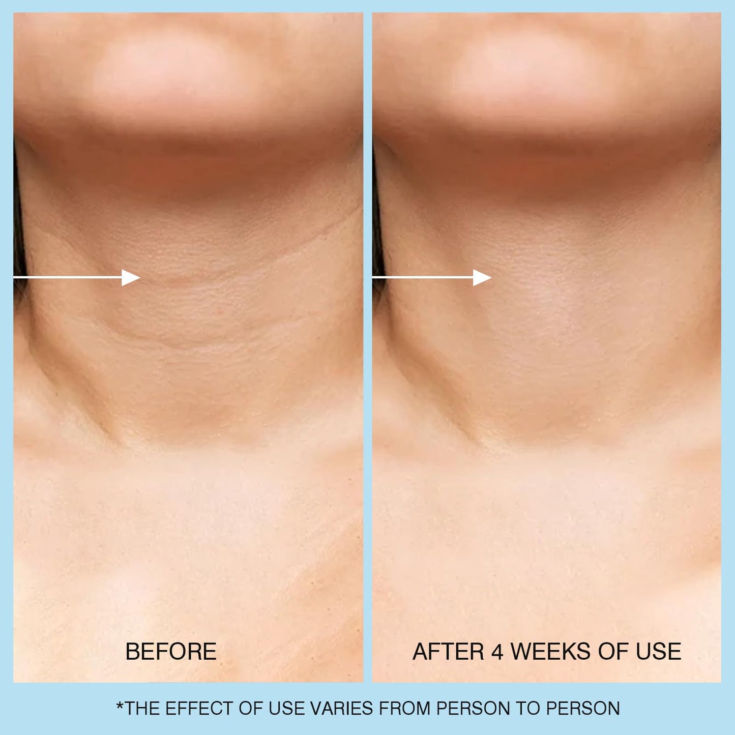 UJhay Retinol Neck Cream, Hyaluronic Acid and Caffeine Enriched Neck Firming Cream to Minimize Fine Lines & Dullness - 3-in-1 Moisturizing Cream for Neck, Chest and Face (50 ml/1.7 oz)