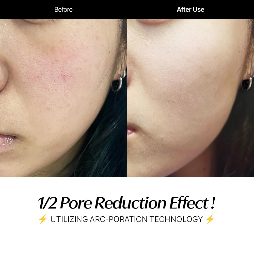 CELORABY Potension Penta-Shot Glass Skin Glow Booster | 5-in-1 Korean Face Device for Pore Minimizing, Black Head Care, Pore Strips Nose, Enhanced Absorption & Needle-Free Treatment at Home