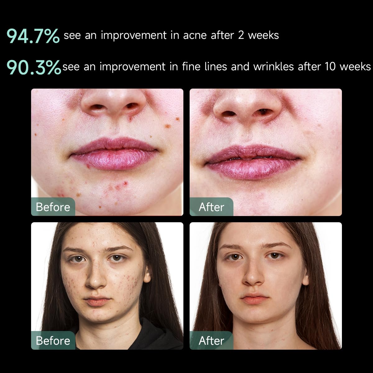 Aphrona® | FDA cleared Moonlight LED Facial Mask Skin Care Mask, LED Light Therapy Red Blue light for Acne Removal Wrinkle Reduction