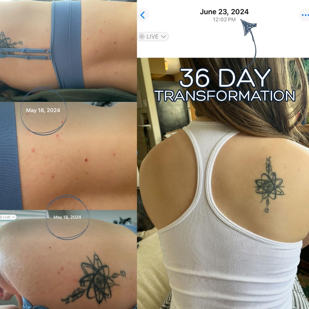 Bacne Wash: All Natural Back Acne Treatment with Charcoal, Jojoba Oil, Tea Tree Oil, Neem Oil, Aloe Vera, and Vitamin E - Body Acne Wash for All Skin Types