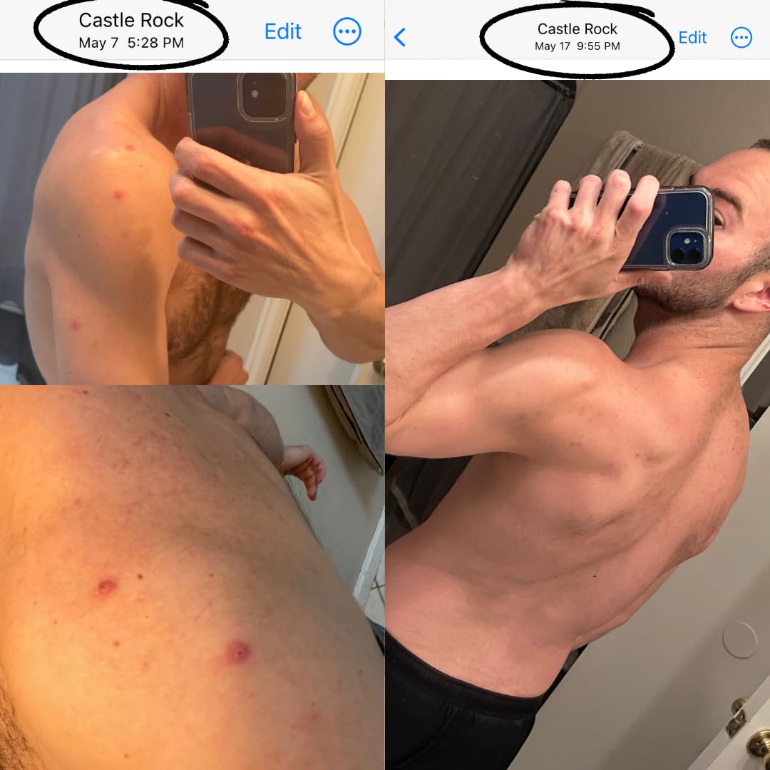 Bacne Bar: All Natural Body Acne Soap with Charcoal, Pumice, Tea Tree Oil & Vitamin E for a Deep Exfoliation Back Acne Treatment, Not for Sensitive Skin