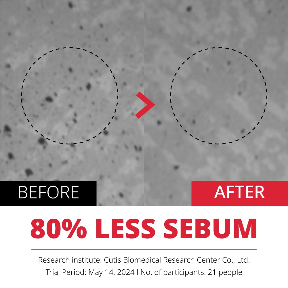 ATOMU Mildly alkaline oily acne sebum removal deep cleansing ACLIS foam cleanser, 4.05 fl.oz.