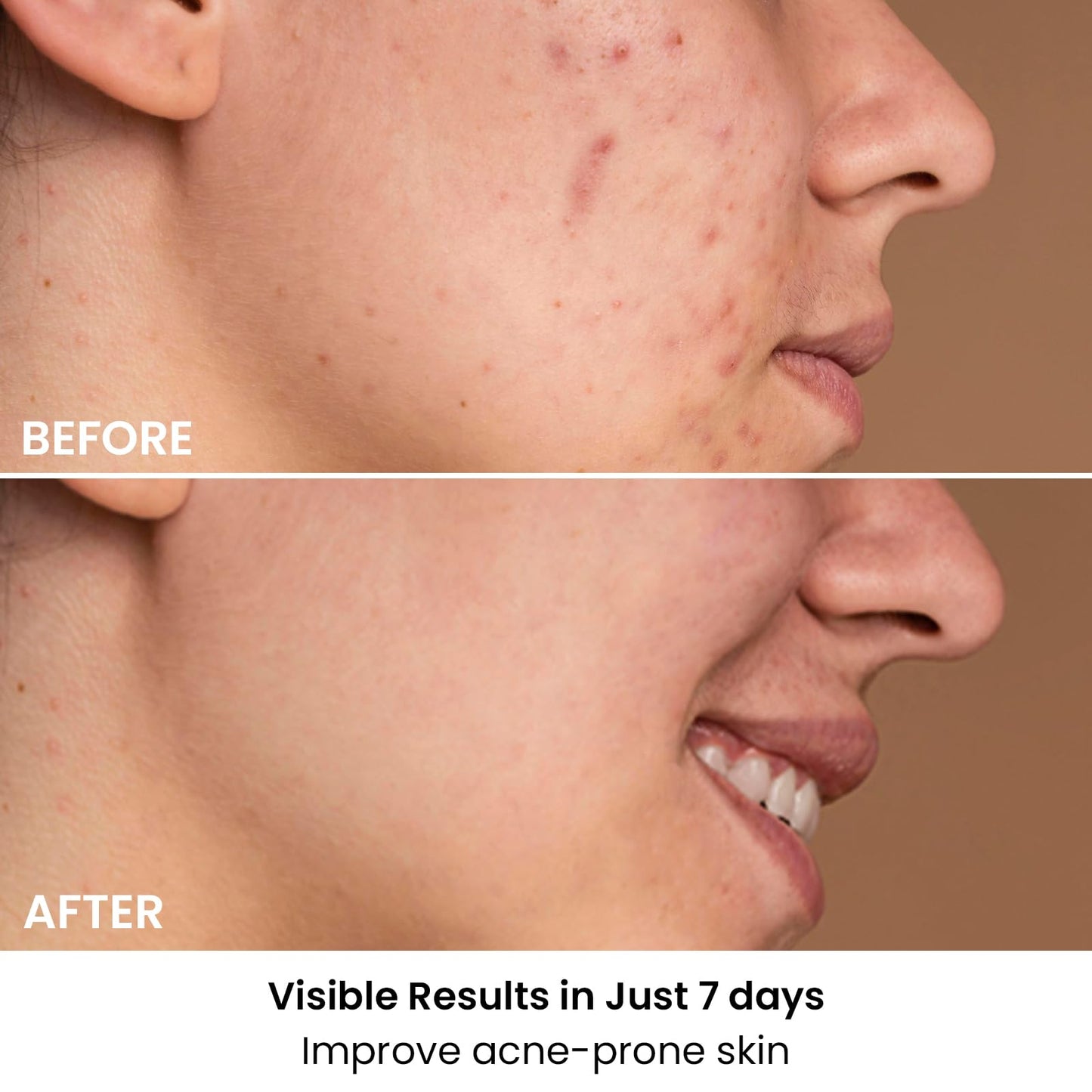 AMIRO Spectra 5-in-1 Light Therapy Face Mask, Contour With Blue, Red, Green, Yellow, and Infrared Light, 3 Modes for Oily, Acne-Prone, and Sagging Skin, Skincare for Face, Silver