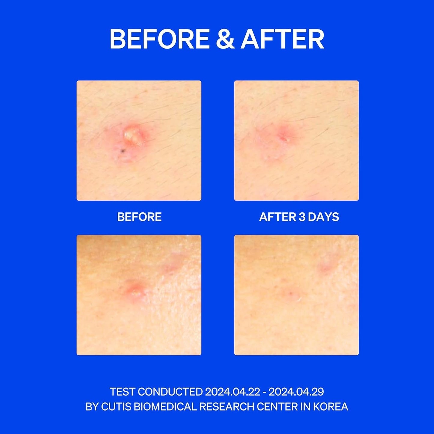 KNEMO Right Away Thincognito Invisible Spot Patch - Absorbing Hydrocolloid Pimple Patch for Face, Blemishes, Zits, Acne, Breakouts Spot Treatment for Skin Care, 2 Sizes (42 Count)