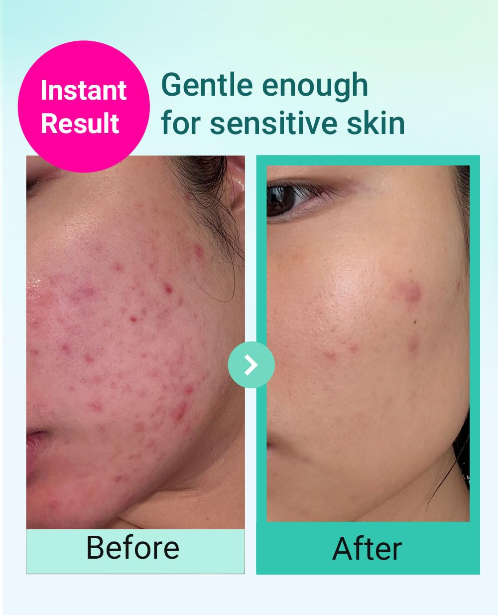 BRING GREEN TEA TREE CICA TRIAL KIT | Travel Size Korean Skin Care Set for Acne-Prone, Sensitive Skin | Zinc Teca Serum, Tea Tree Cica Moisturizer & Deep Cleansing Foam | Hydrating & Oil Control