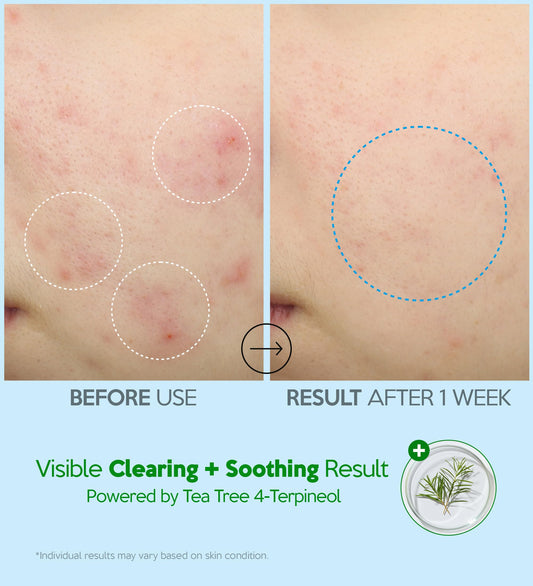 Troubless Hydro Soothing Moisture Cream - Deep Hydration & Skin Barrier Cream for Face w/ 10,000 ppm Panthenol & Tea Tree 4-Terpineol - Soothing & Non-Greasy Face Moisturizer (2.36 fl oz)