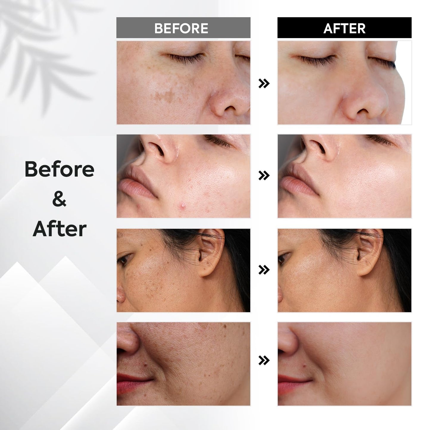 Dark Spot Remover for Face and Body with 360-Degree Roller, Dark Spot Corrector Serum, Dark Spot Remover for Body, Age Spot Sun Spot Freckles Brown Spot Remover(0.5 Fl Oz)