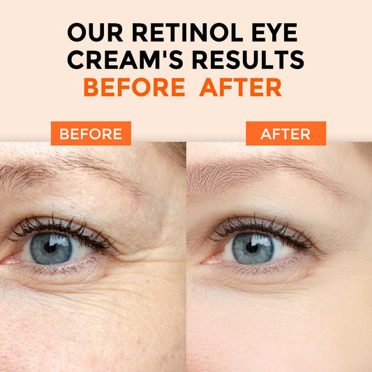 +1HEROLABS Retinol Eye Cream for Dark Circles and Puffiness, Anti Aging Under Eye Cream with Hyaluronic Acid, Retinol & Collagen to Fight Fine Lines, Wrinkles & Dark Spots