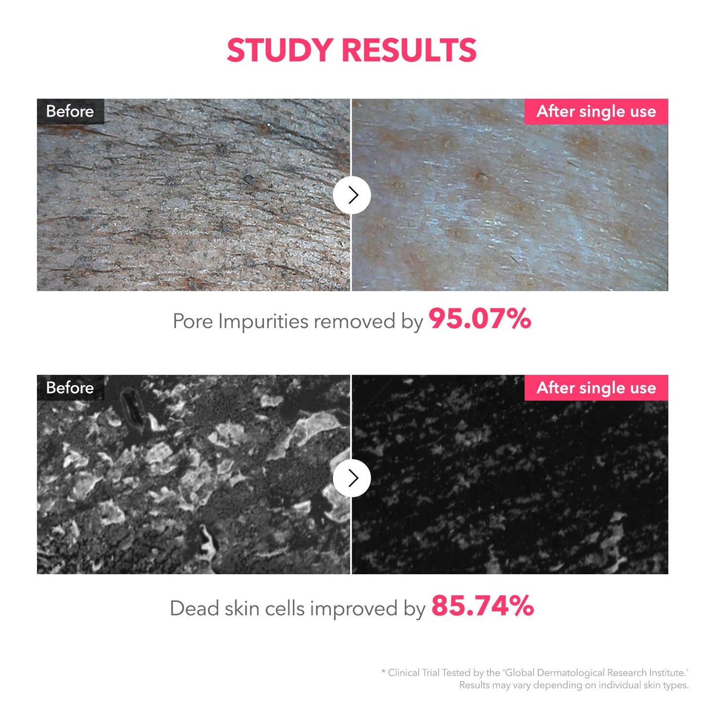 APRILSKIN TXA Niacinamide 99 Pore Care Pink Bubble Gum Deep Cleanser | 99% High-Purity TXA+Niacinamide | All-in-One Cleanser: Deep Cleansing, Blackhead Care, Pore Care, Moisturizing | 4.23 fl.oz.