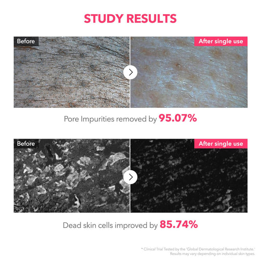 APRILSKIN TXA Niacinamide 99 Pore Care Pink Bubble Gum Deep Cleanser | 99% High-Purity TXA+Niacinamide | All-in-One Cleanser: Deep Cleansing, Blackhead Care, Pore Care, Moisturizing | 4.23 fl.oz.