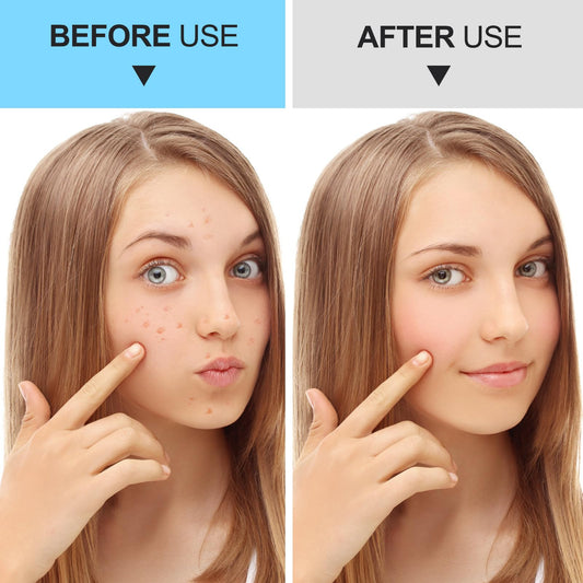 Blackhead Remover Tools Pimple Popper Tool Kit Comedones Extractor Acne Removal Kit for Whitehead, Blemish, Popping. 5pcs Pimple Extractor with Blackhead Tweezers for Nose Face