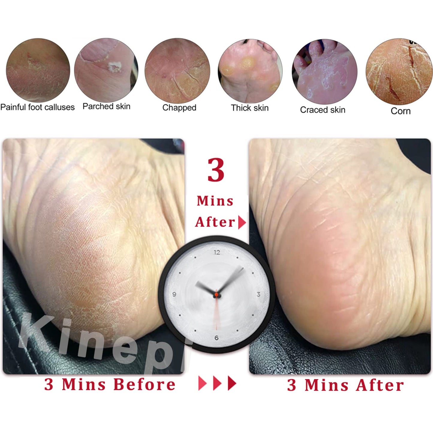 Kinepi Callus Remover Foot Scrubber Colossal Foot File Foot Care and Foot Exfoliator Foot Rasp Pedicure Tools Pumice Stone for Feet,Remove Corn Hard Skin Dead Skin for Use in Shower Foot Scraper Kit