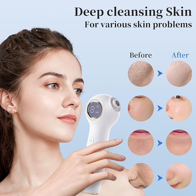 Blackhead Extractor with Camera, Black Head Remover for Face,Pore Extractor for Black Head and Acen, Blackhead Remover Tools with USB Rechargeable, Blackhead Remover Vacuum (White)