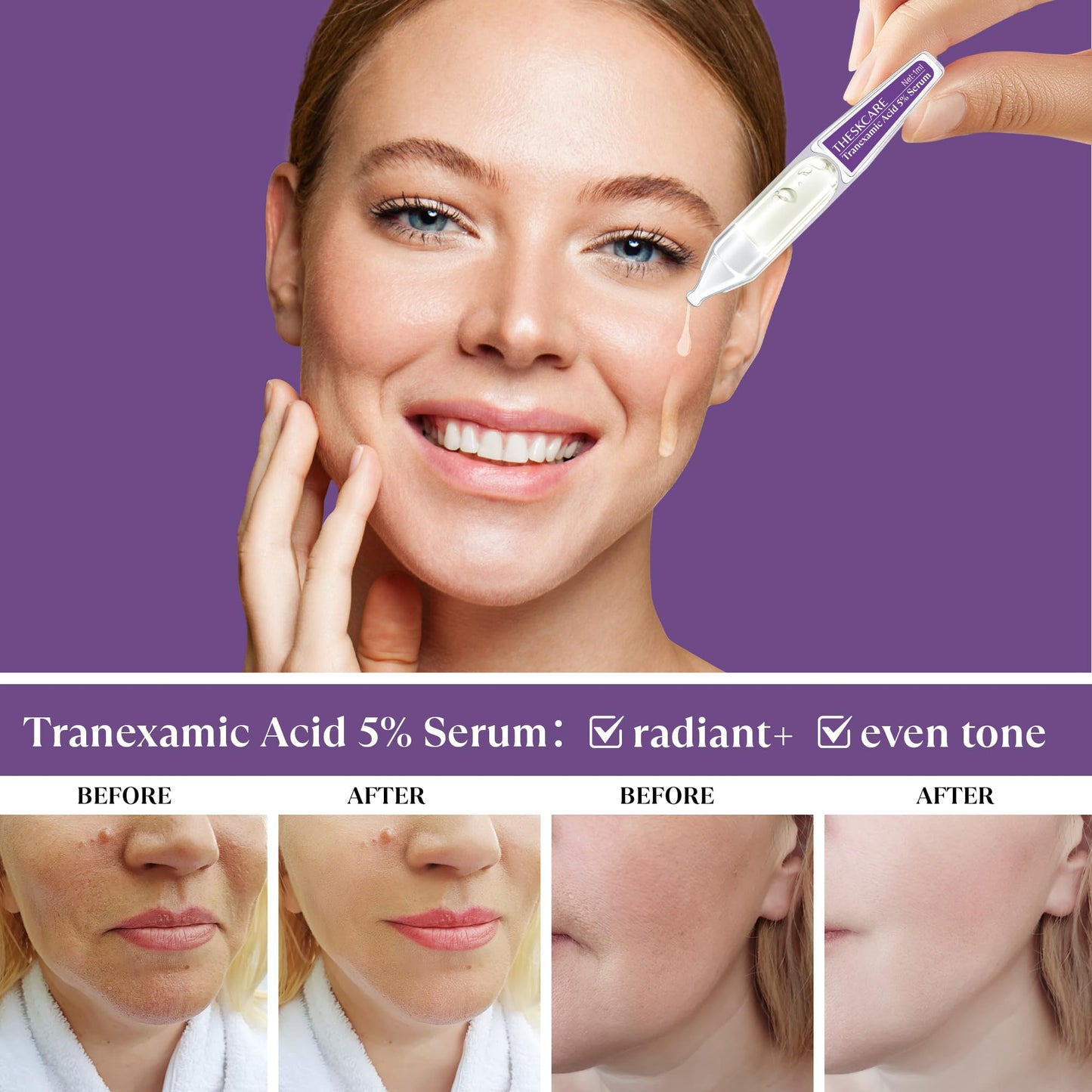 THESKCARE 5% Tranexamic Acid Serum for Face - Dark Spot Corrector for Melasma & Hyperpigmentation - Brightening Serum for Uneven Skin Tone - 30x1ml Single-Use Ampoules (30-Day Supply)