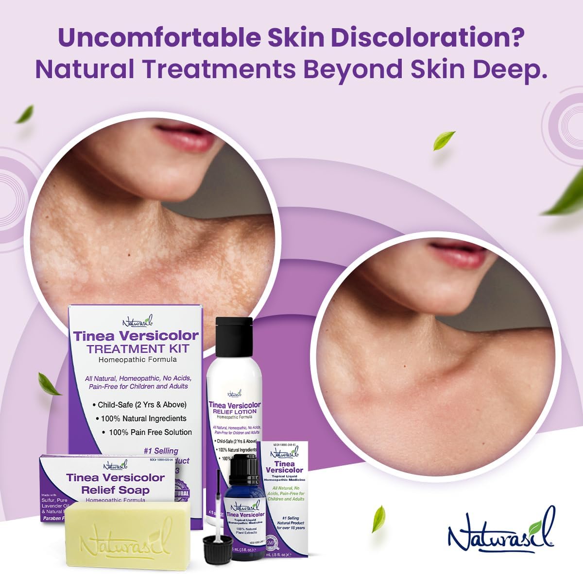 Naturasil Tinea Versicolor Treatment Max-Strength 10x Soap | Antifungal Micronized Sulfur | Stops Tinea, Pityriasis, Candida, Ringworm Jock Itch & Irritation | Fast Acting Adult & Kid Safe | 4 oz Bar