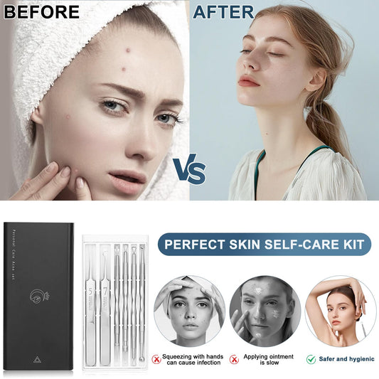 Professional Facial Blackhead Remover Tools,6-Piece Stainless Steel Acne Extractor Tools Set with Storage CaseKit for Whitehead Acne Blemishes Comedones Stainless Steel Makeup Tool