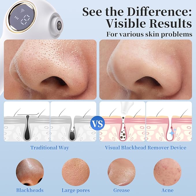 Blackhead Extractor with Camera, Black Head Remover for Face,Pore Extractor for Black Head and Acen, Blackhead Remover Tools with USB Rechargeable, Blackhead Remover Vacuum (White)