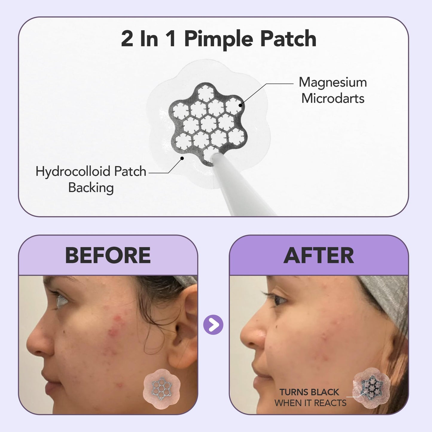 Magnesium Blemish Microdarts | Pimple Patch | Fast-Acting | Quick Calming | 99.9% Pure Magnesium | Madecassic Acid | Tea Tree | Eucalyptus Leaf | Hydrocolloid Spot Care Patch (MEDIUM 8 PATCHES)