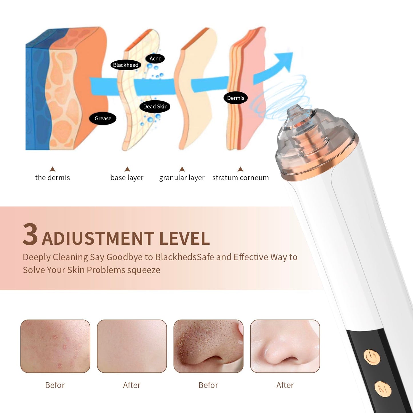 Blackhead Remover Pore Vacuum,Facial Pore Cleaner-6 Suction Power,3 Adjustable Suction Levels,USB Rechargeable Blackhead Vacuum Kit Electric Acne Extractor Tool for Women & Men (Off White)