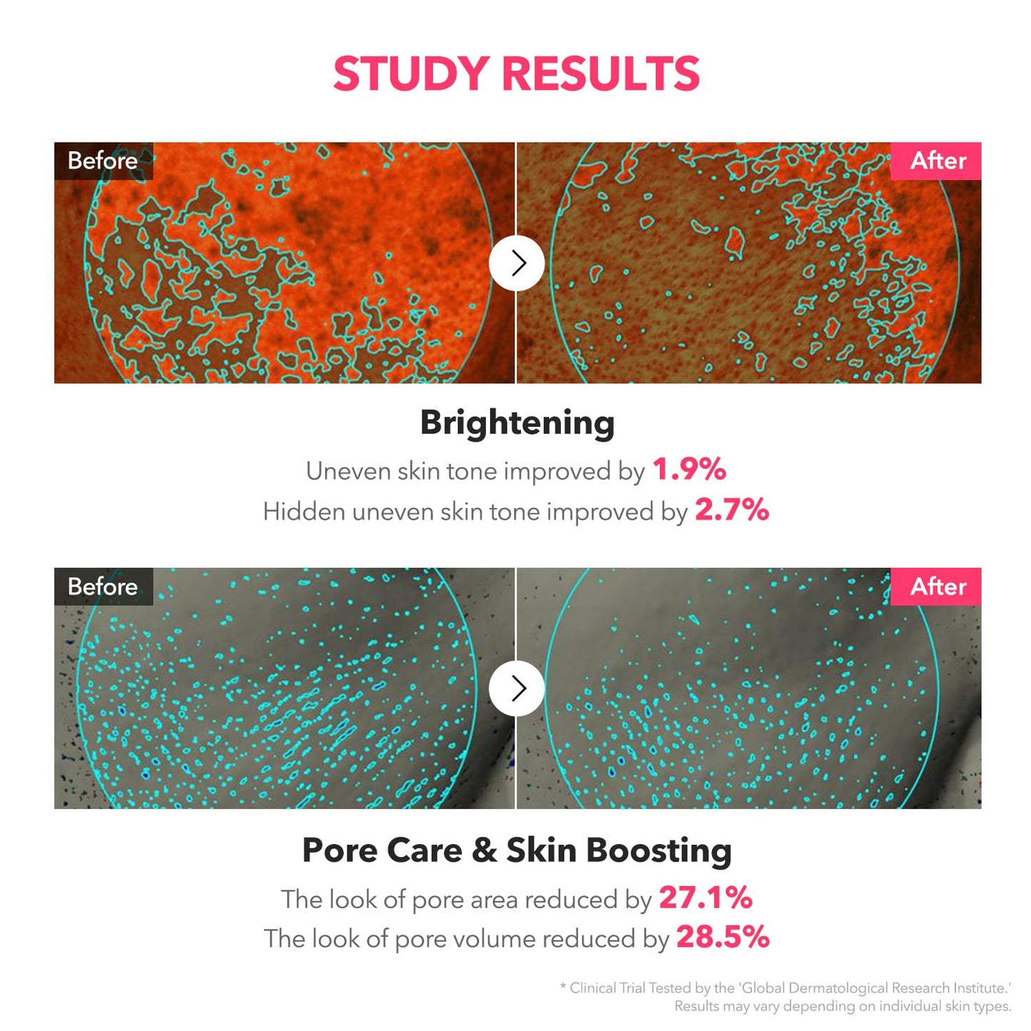 APRILSKIN TXA Niacinamide Toning Shot 99 Spicule Facial Serum｜Skin Booster Serum for Brightening and Pore Care｜99% High-Purity Tranexamic Acid 3% + Niacinamide 5%｜Korean Skin Care｜1.01 fl. oz.