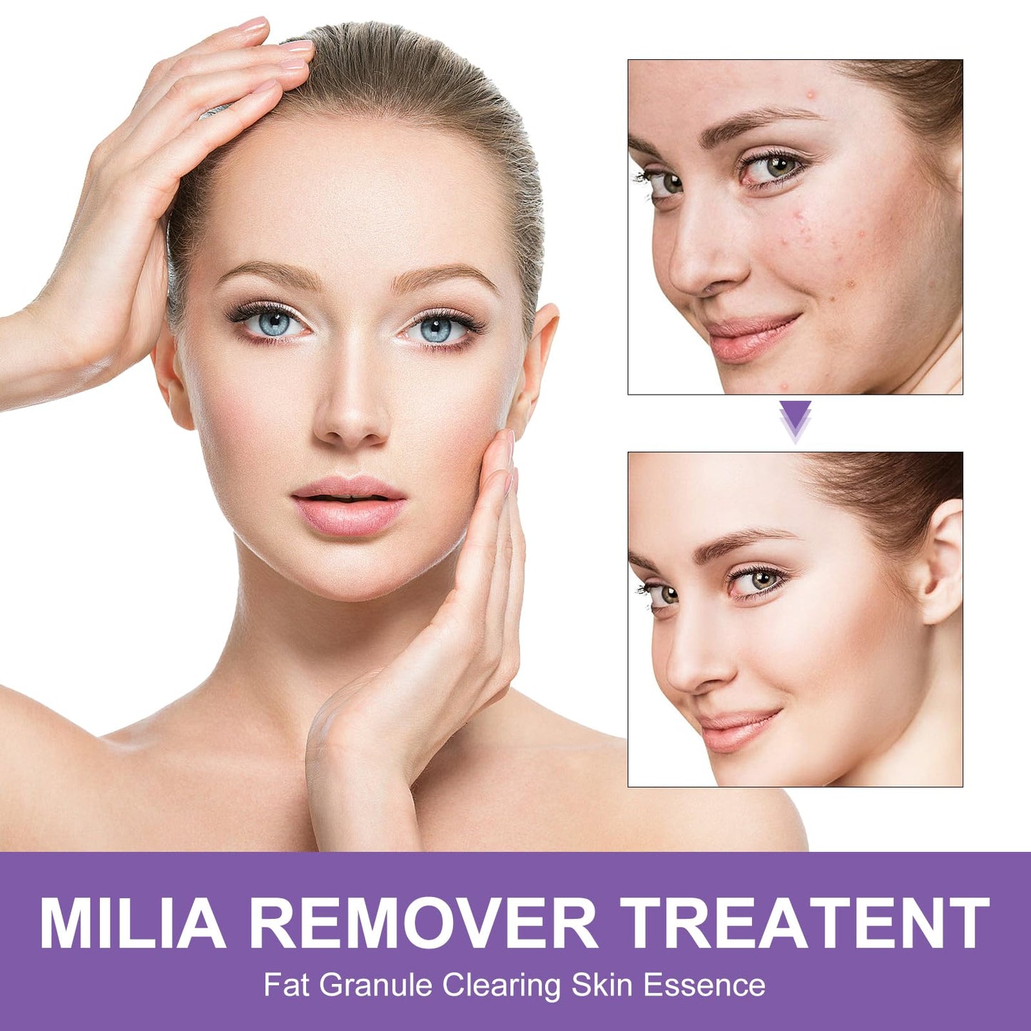 Milia Remover Cream for Eyes and Face,Milia Spot Remover with Salicylic Acid,Milia Acne Cream(1 Fl Oz (Pack of 1))