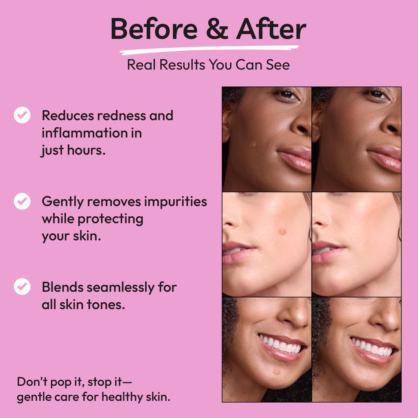 Clear Molecules Spot Stoppers Pimple Patches - Invisible Spot Patches for Acne Treatment, Hydrocolloid Patches for Spot Treatment, Vegan & Cruelty Free Korean Skincare (30 Count (Pack of 1))