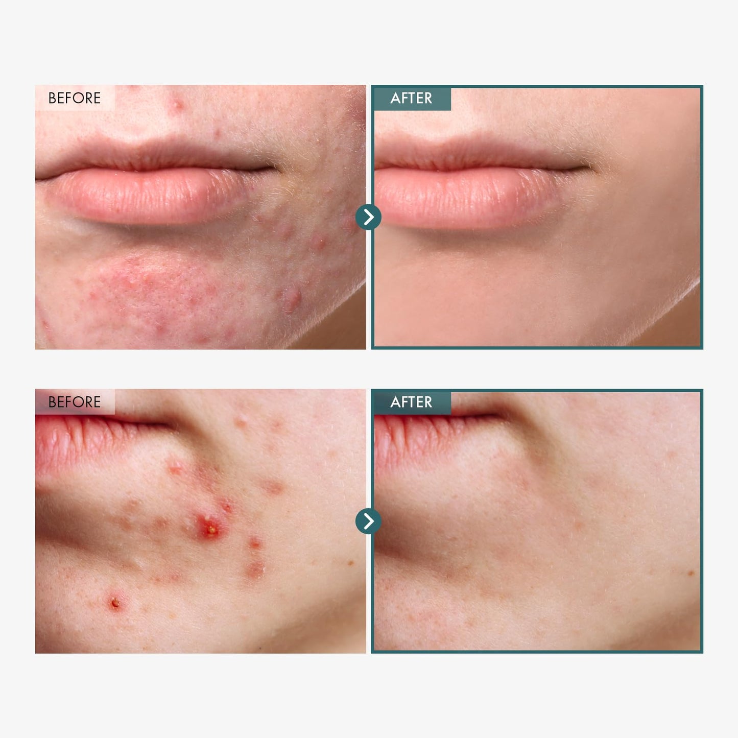 TOSOWOONG Adenosine Cica Cream, 520,000ppm Centella Asiatica, Redness Reducing for Oily and Dry Skin Moisturizer, Barrier Cream with Niacinamide and Panthenol, Korean Skincare, 100ml, 3.38 fl. oz.