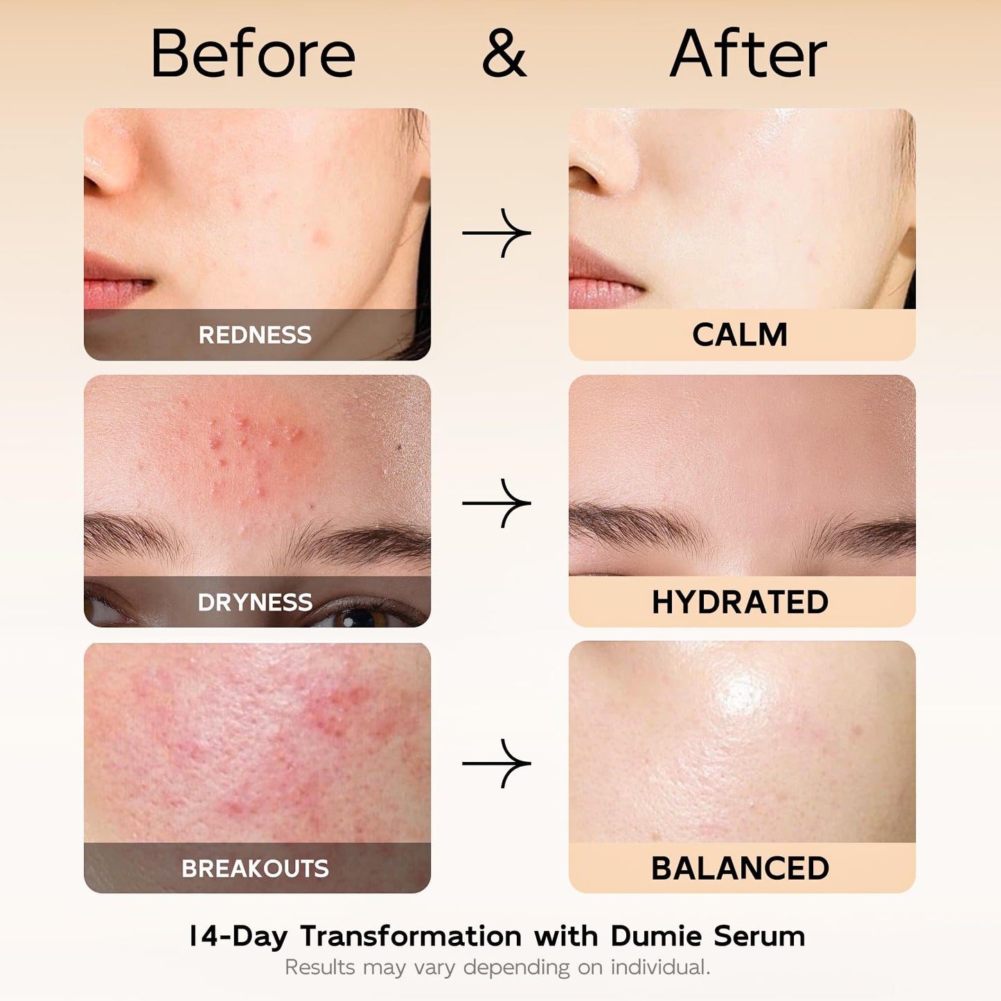 Azelaic Acid Serum 10%, Azelaic Acid for Face with Centella Asiatica Serum for Redness and Uneven Skin Tone, Hyaluronic Acid & Ceramide 3 – Soothes & Clears Pores for Sensitive Skin, 1.01 fl oz