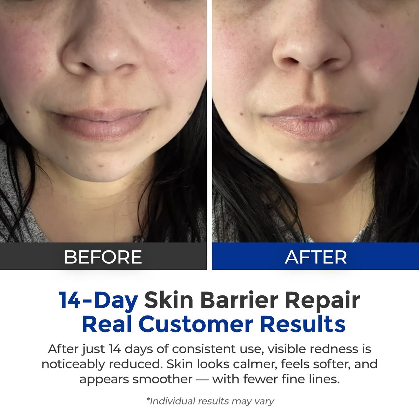 SKINERSE Intensive Repair Serum, 15%Hyaluronic Acid for Sensitive Skin Anti Aging Ultra Hydrating Serum for Face Calming Barrier Repair Redness Relief with Ceramides Centella 30Vials Daily Travel Care