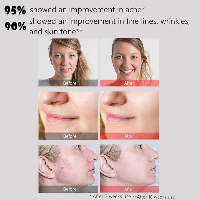 Aphrona Led Face Mask Light Therapy, Halo Led Light Therapy Facial and Neck Skin Care Mask, Blue Light Red Light for Acne Wrinkle Reduce, New Generation Face and Neck Photon Mask