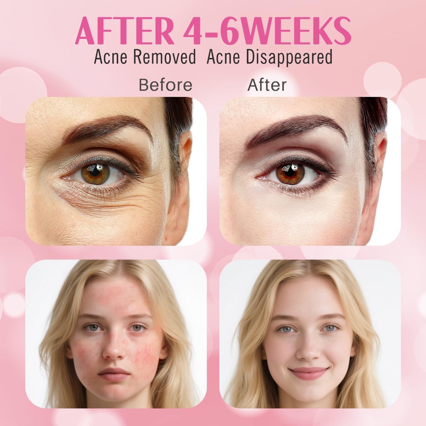 Auxoliev FSA Pro LED Light Therapy Facial Mask- Target Acne Removal, Wrinkles & Redness with Salon-Level Light Therapy at Home,Restore Skin