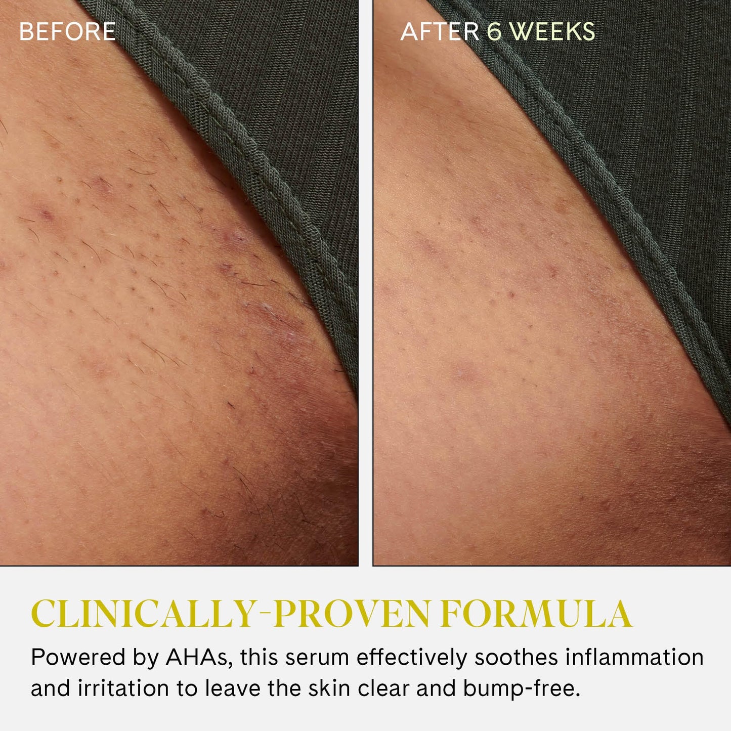 Fur Ingrown Eliminator Serum Rollerball Travel Size - Powerful Ingrown Hair Treatment Serum With AHAs and BHAs to Treat and Prevent Ingrown Hairs and Bumps, Hydrates and Soothes Irritated Skin - 10 ml