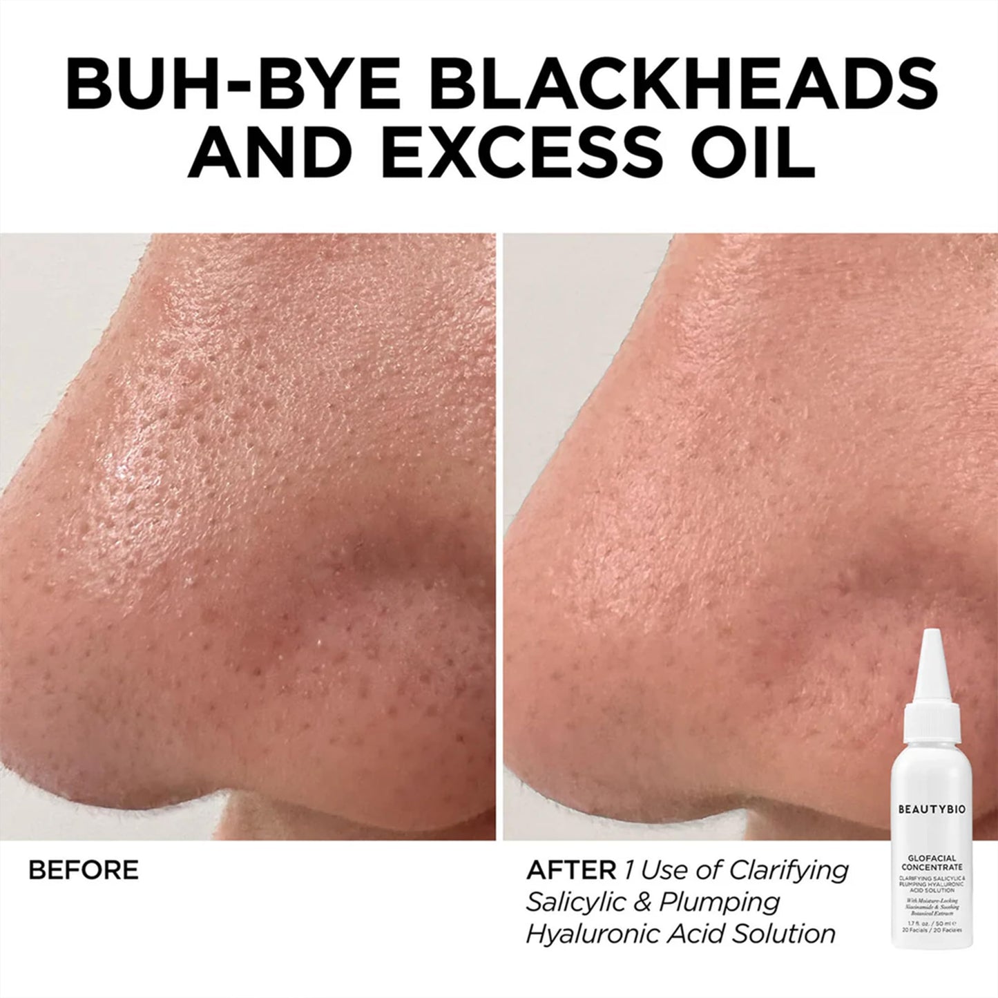 BeautyBio GLOfacial Hydro-Infusion Deep Pore Cleansing + Blue LED Clarifying Tool & Concentrates